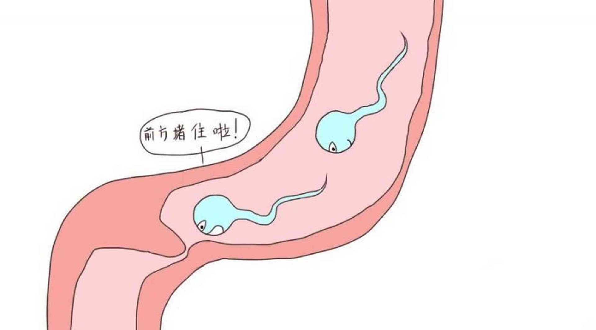 双侧输卵管堵塞.png